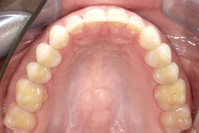 Fossil Creek Dental smile makeover after — Fort Worth, TX