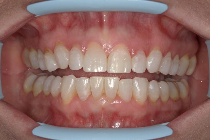 Fossil Creek Dental smile makeover after — Fort Worth, TX