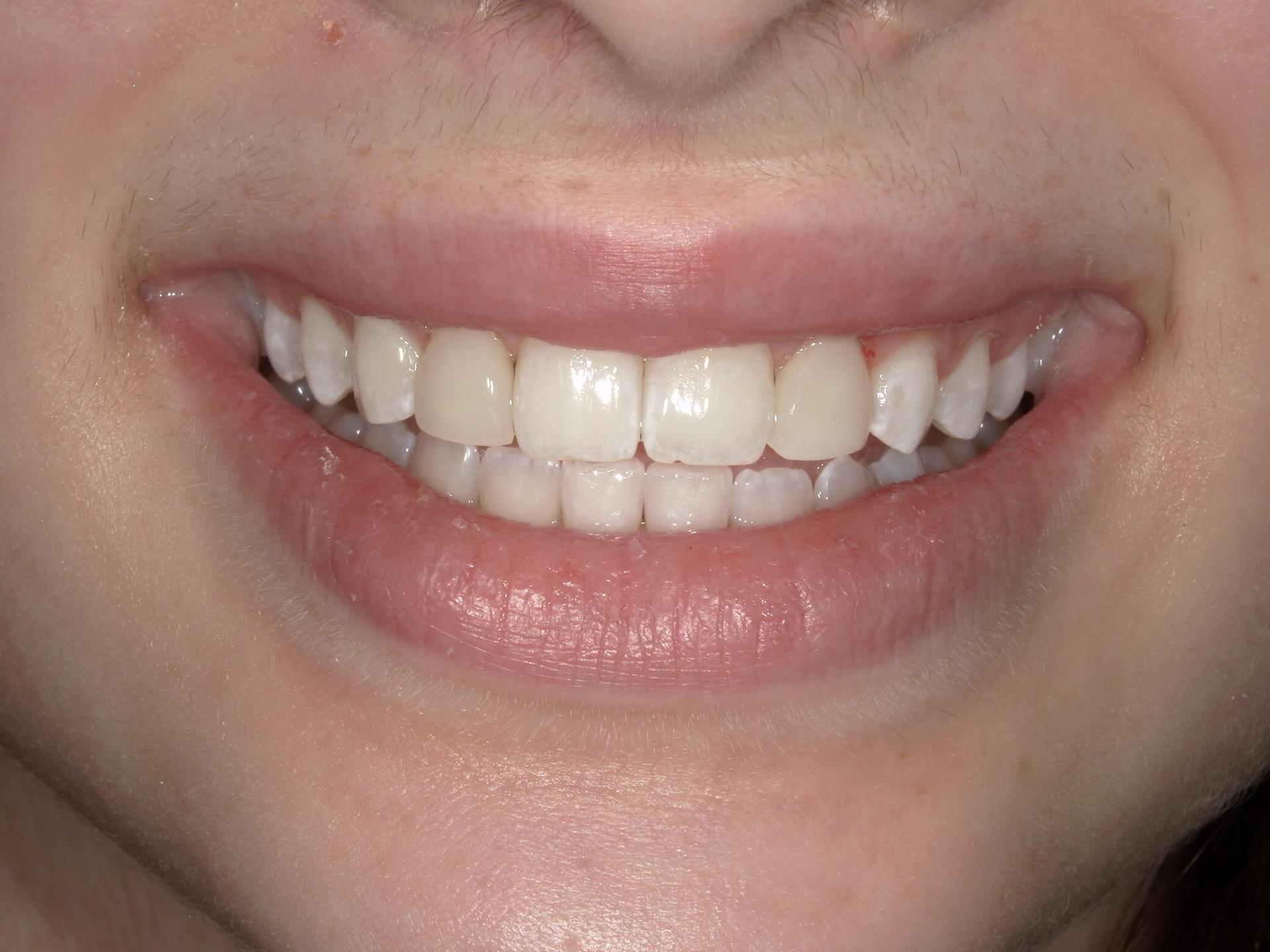 Fossil Creek Dental smile makeover after — Fort Worth, TX