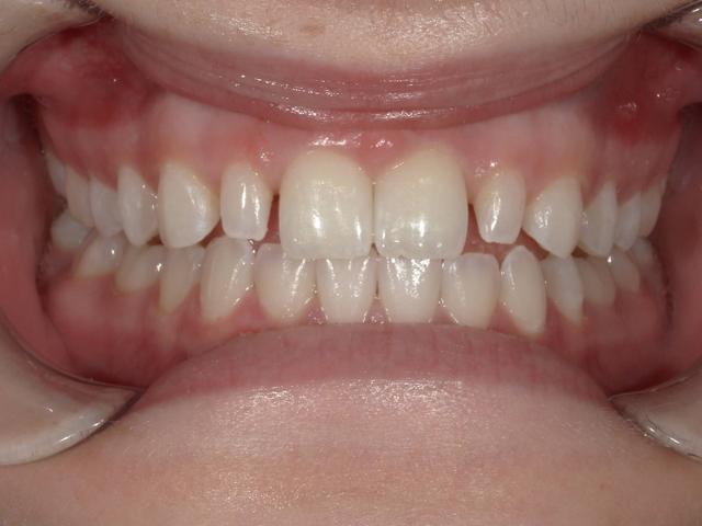 Smile Makeover before at Fossil Creek Dental in Fort Worth, TX