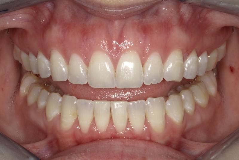 Fossil Creek Dental smile makeover after — Fort Worth, TX