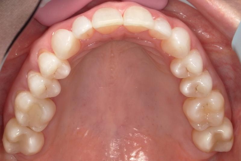 Fossil Creek Dental smile makeover after — Fort Worth, TX