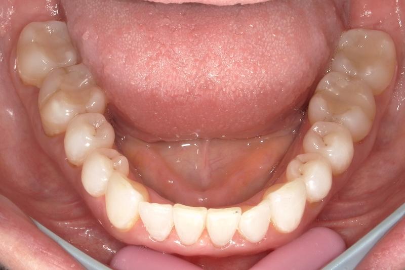 Fossil Creek Dental smile makeover after — Fort Worth, TX