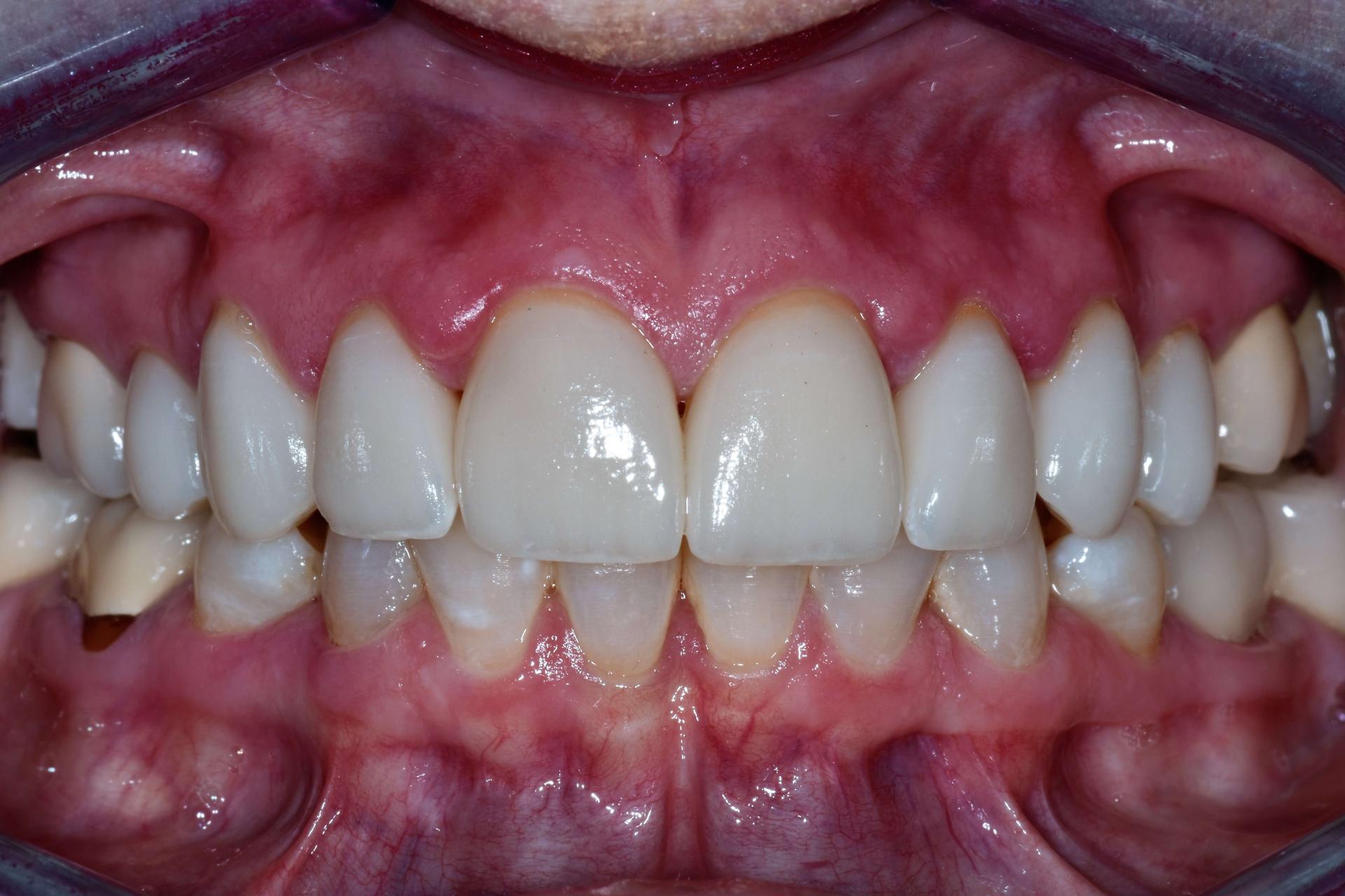 Fossil Creek Dental smile makeover after — Fort Worth, TX