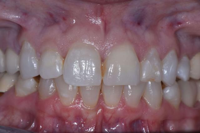 Smile Makeover before at Fossil Creek Dental in Fort Worth, TX
