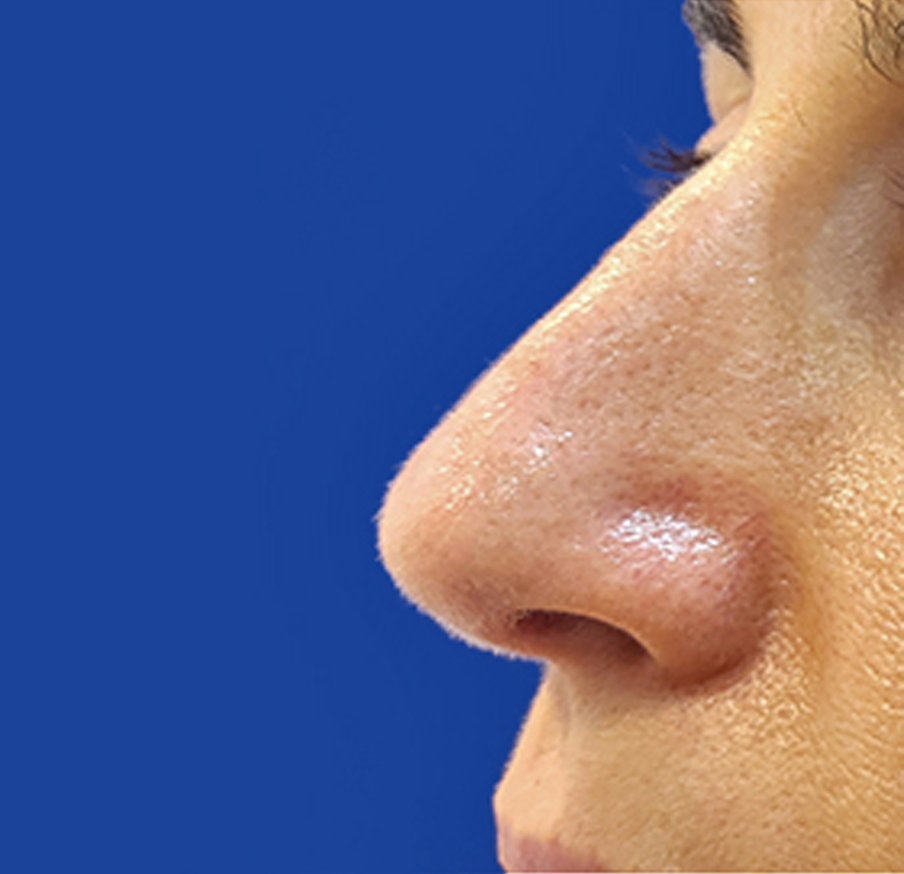 Dr. Tal Dagan, MD, FACS rhinoplasty after — New York, NY