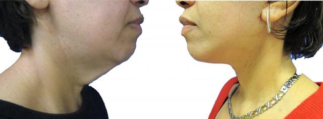 Facelift result at Dr. Tal Dagan, MD, FACS in New York, NY