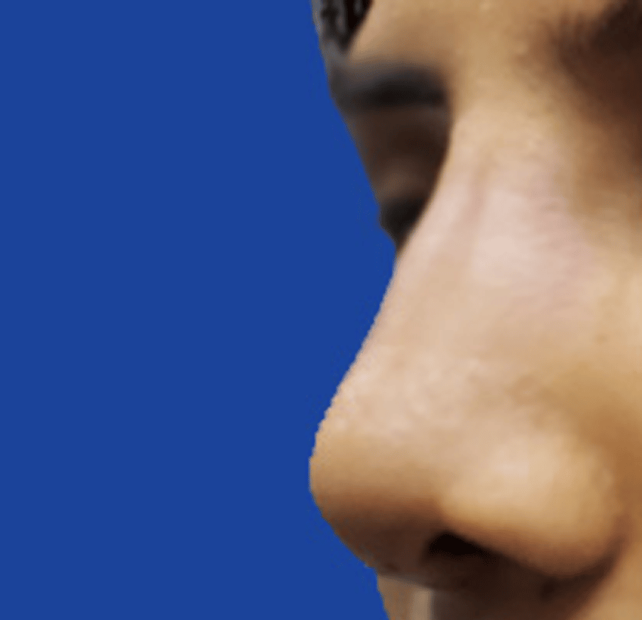 Dr. Tal Dagan, MD, FACS rhinoplasty after — New York, NY