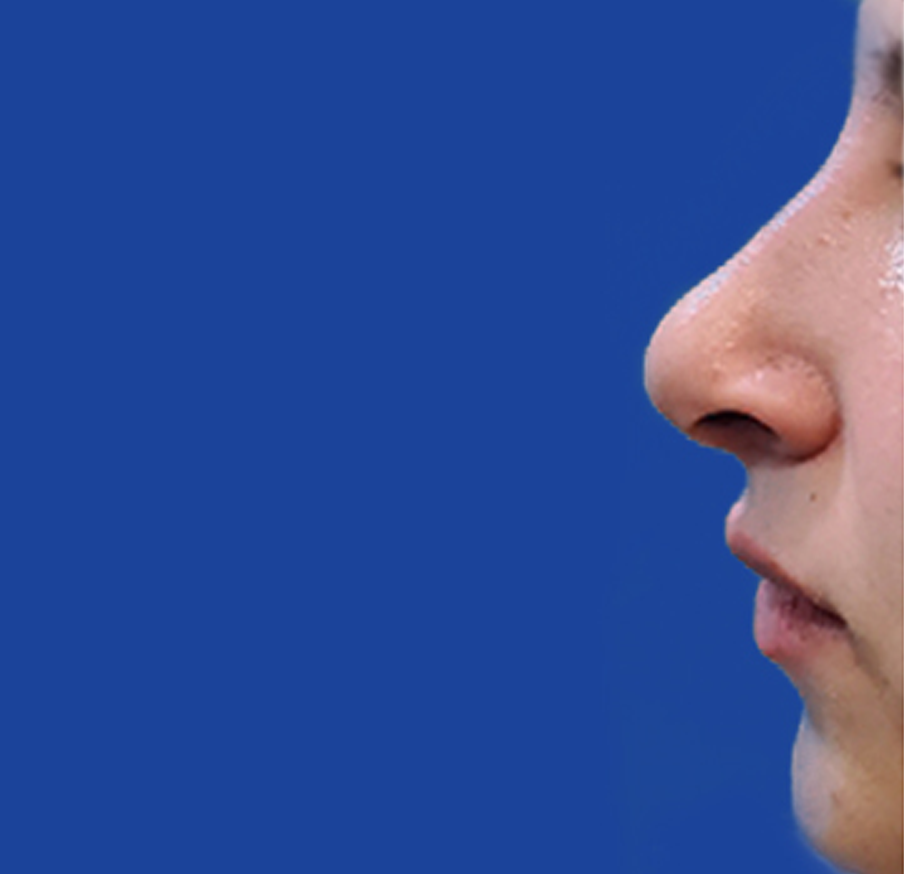 Dr. Tal Dagan, MD, FACS rhinoplasty after — New York, NY