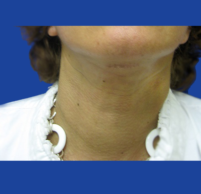 Neck Lift after at Dr. Tal Dagan, MD, FACS in New York, NY