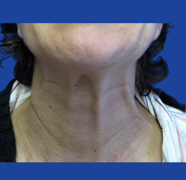 Neck Lift before at Dr. Tal Dagan, MD, FACS in New York, NY
