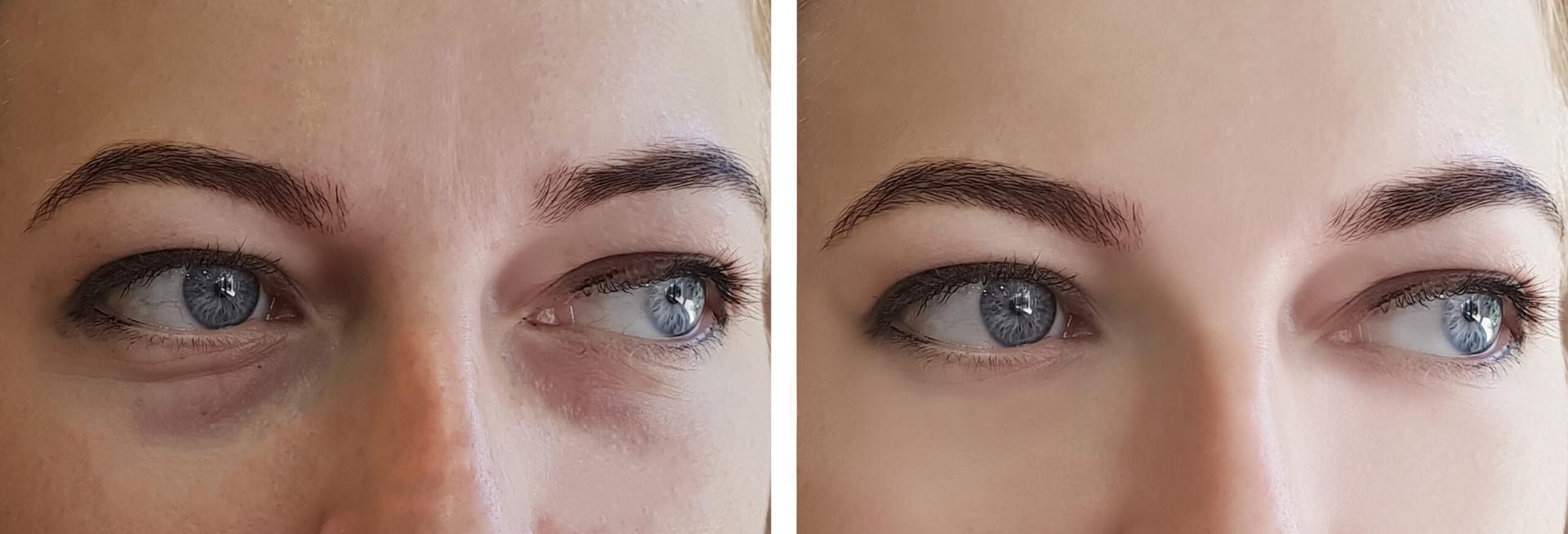 Dr. Tal Dagan, MD, FACS blepharoplasty result — New York, NY