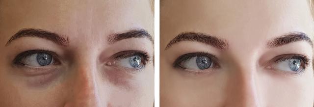 Blepharoplasty result at Dr. Tal Dagan, MD, FACS in New York, NY