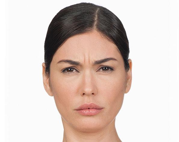 Botox before at Dr. Tal Dagan, MD, FACS in New York, NY