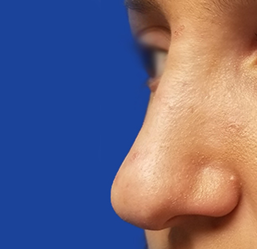Dr. Tal Dagan, MD, FACS rhinoplasty after — New York, NY