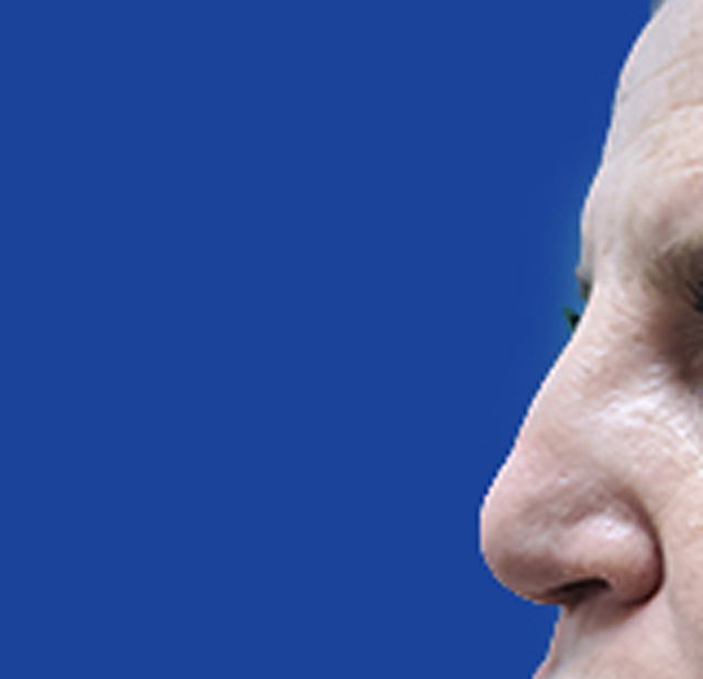 Rhinoplasty after at Dr. Tal Dagan, MD, FACS in New York, NY
