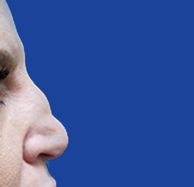Rhinoplasty before at Dr. Tal Dagan, MD, FACS in New York, NY