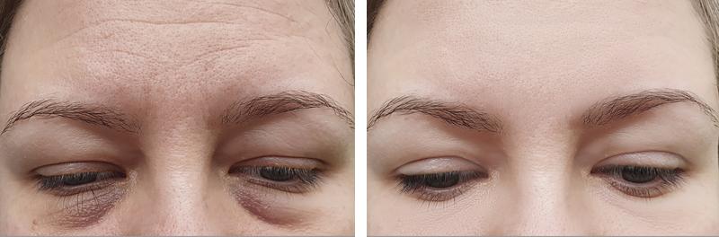 Dr. Tal Dagan, MD, FACS blepharoplasty result — New York, NY