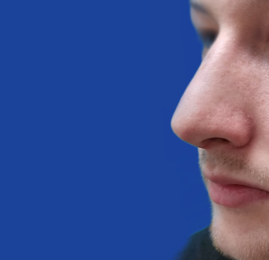 Dr. Tal Dagan, MD, FACS rhinoplasty after — New York, NY