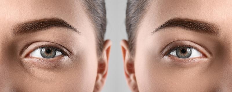 Dr. Tal Dagan, MD, FACS blepharoplasty result — New York, NY