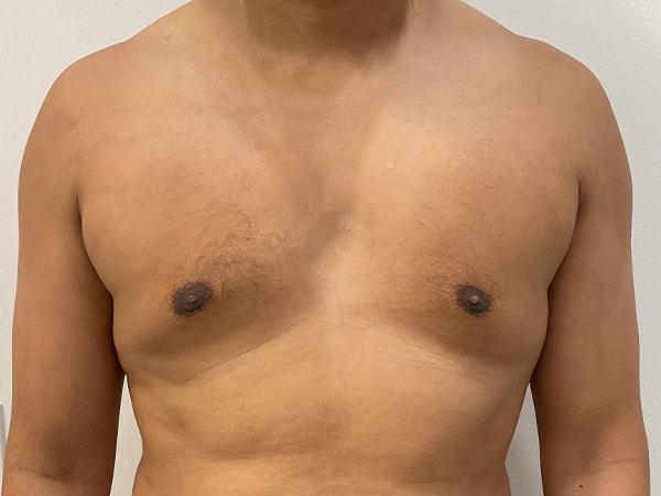 Beauty by Balinger (Christopher Balinger, MD) gynecomastia after — Houston, TX