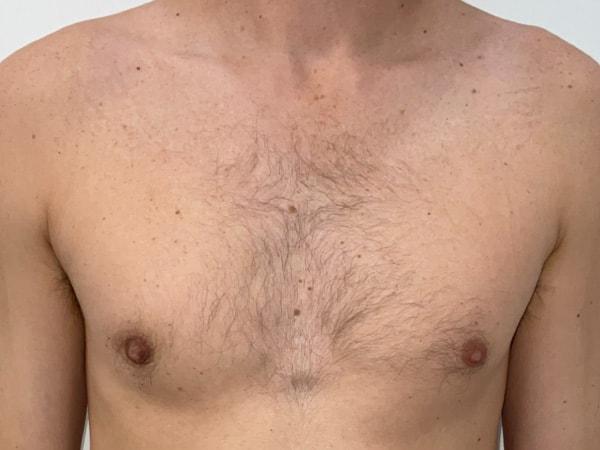 Beauty by Balinger (Christopher Balinger, MD) gynecomastia after — Houston, TX