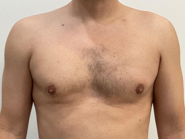 Beauty by Balinger (Christopher Balinger, MD) gynecomastia after — Houston, TX