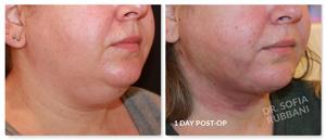 Neck Liposuction result at Tucson Cosmetics in Tucson, AZ