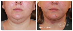 Neck Liposuction result at Tucson Cosmetics in Tucson, AZ