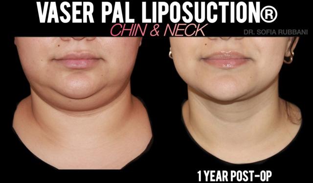 Neck Liposuction result at Tucson Cosmetics in Tucson, AZ