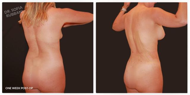 Liposuction result at Tucson Cosmetics in Tucson, AZ