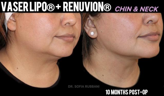Neck Liposuction result at Tucson Cosmetics in Tucson, AZ