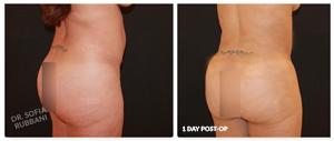 Brazilian Butt Lift result at Tucson Cosmetics in Tucson, AZ
