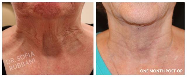Neck Lift result at Tucson Cosmetics in Tucson, AZ