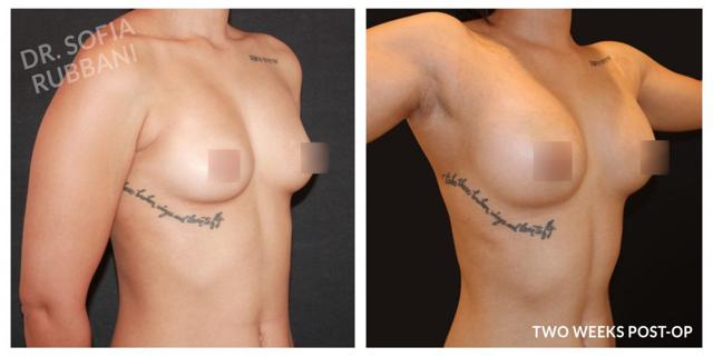 Breast Augmentation result at Tucson Cosmetics in Tucson, AZ