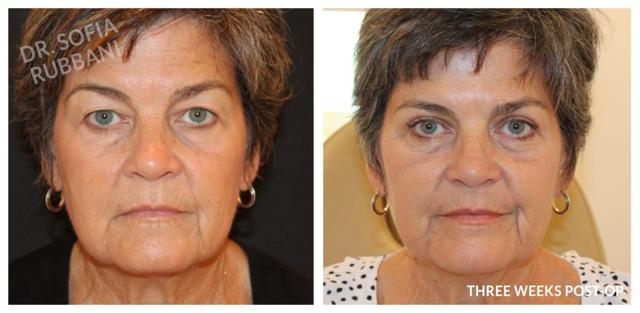 Blepharoplasty result at Tucson Cosmetics in Tucson, AZ