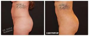Brazilian Butt Lift result at Tucson Cosmetics in Tucson, AZ