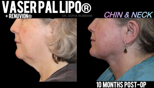 Neck Liposuction result at Tucson Cosmetics in Tucson, AZ