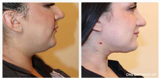 Neck Liposuction result at Tucson Cosmetics in Tucson, AZ