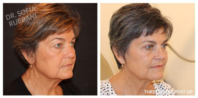 Deep Plane Facelift result at Tucson Cosmetics in Tucson, AZ