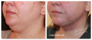 Neck Liposuction result at Tucson Cosmetics in Tucson, AZ