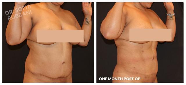 Mini Tummy Tuck result at Tucson Cosmetics in Tucson, AZ