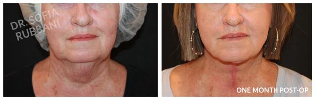 Neck Lift result at Tucson Cosmetics in Tucson, AZ