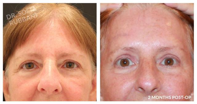 Brow Lift result at Tucson Cosmetics in Tucson, AZ