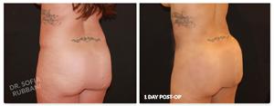 Brazilian Butt Lift result at Tucson Cosmetics in Tucson, AZ