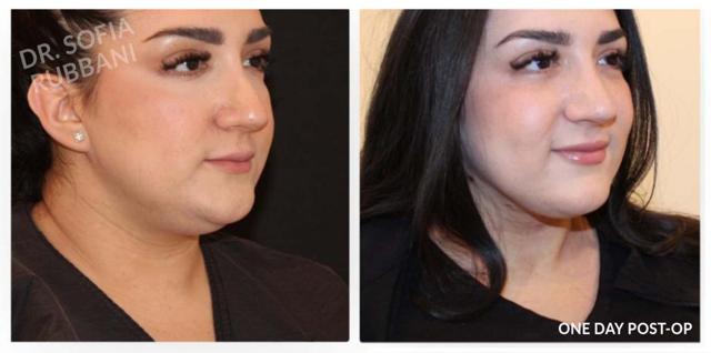 Neck Liposuction result at Tucson Cosmetics in Tucson, AZ