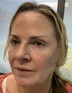 Eyelid Surgeons of Tampa Bay eyelid lift after — St. Petersburg, FL