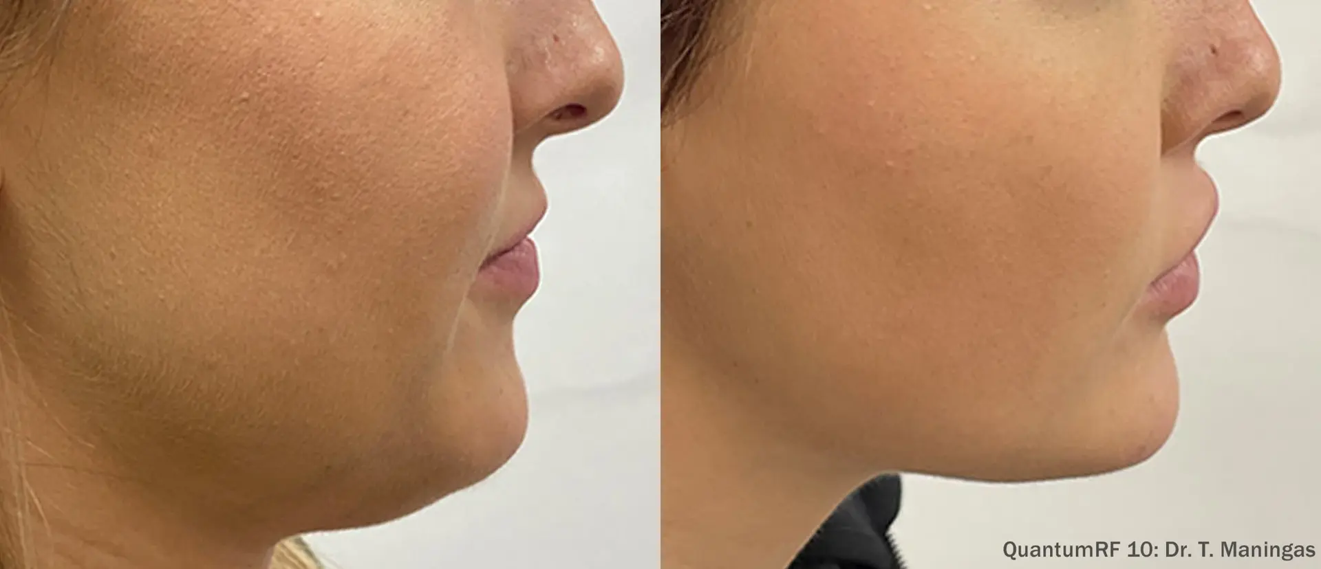 Endure Aesthetics & Wellness skin tightening result — Grove City, OH