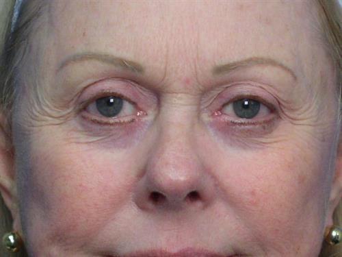 Laser Skin Resurfacing before at Adrian Yi, MD in Los Angeles, CA