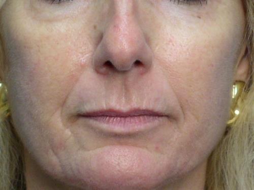 Adrian Yi, MD laser treatment after — Los Angeles, CA